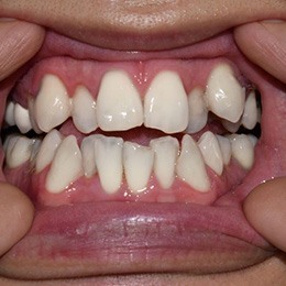 Close-up photo of person’s crowded and crooked teeth