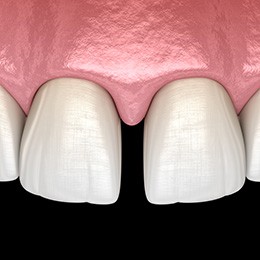 Digital image showing gap between two front teeth