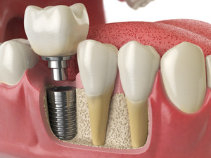 Picture of a dental implant