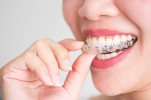 Close up of woman inserting Invisalign aligners