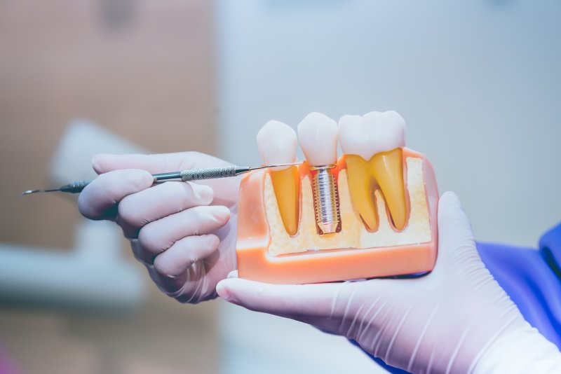 Dentist pointing to a dental implant model