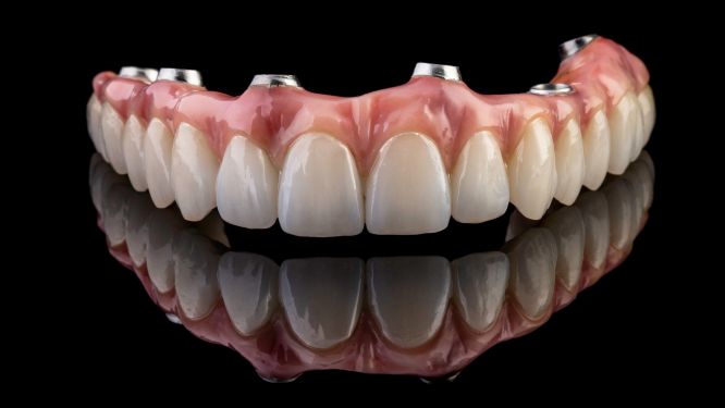 An implant denture